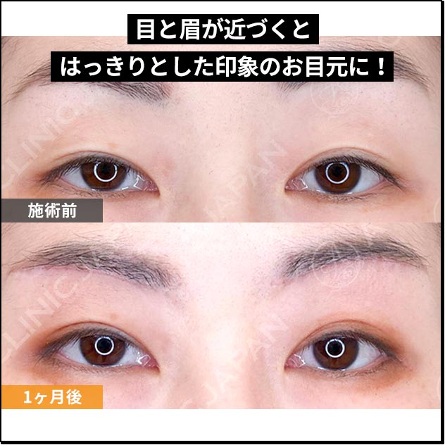 目と眉が近づくとはっきりした印象のお目元に！